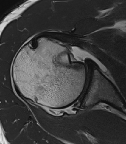 Posterior Shoulder Dislocation 2